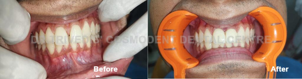 Dental Implants Case