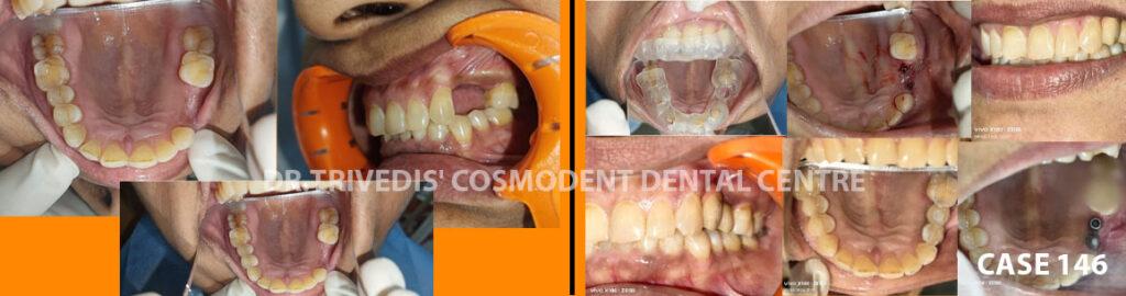 Implants CASE 146