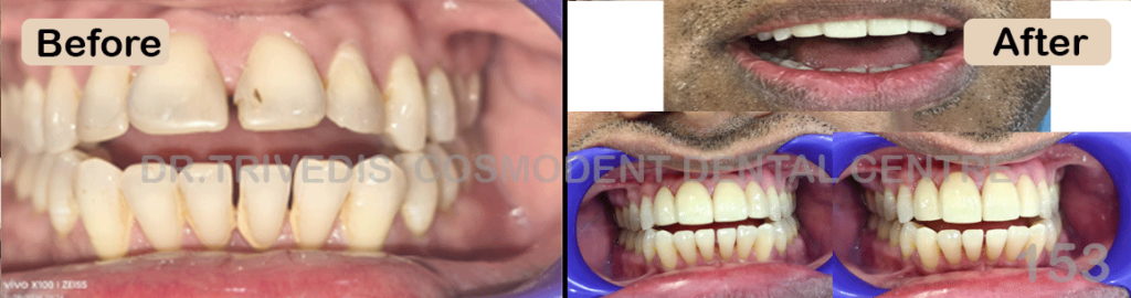 CASE 153 Treatment Veneers