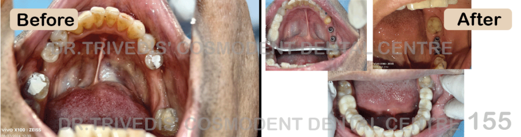 CASE 155 Implant