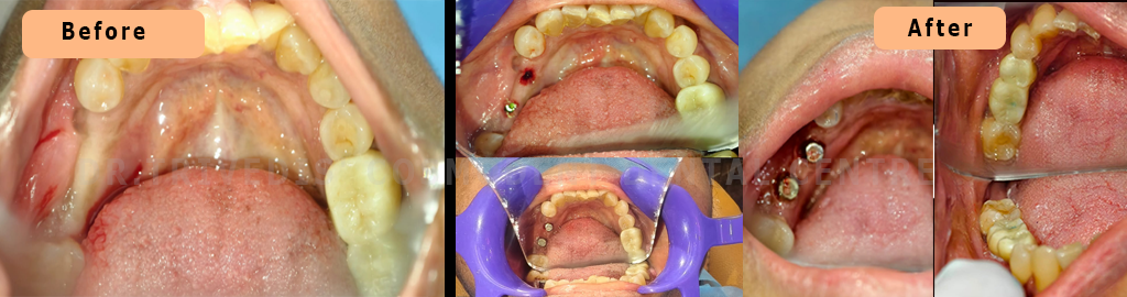 CASE 170  Implants Case