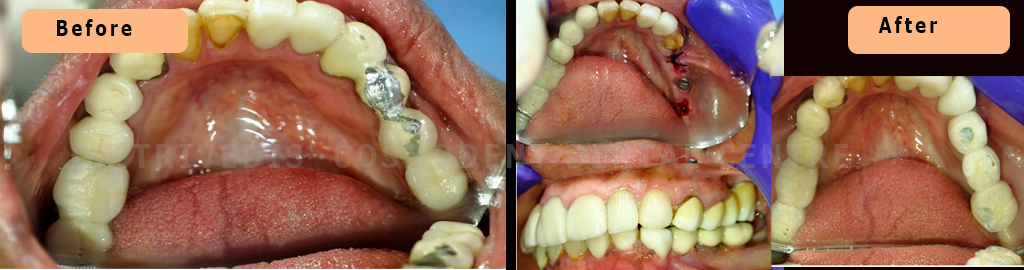 CASE 171  Implants Case