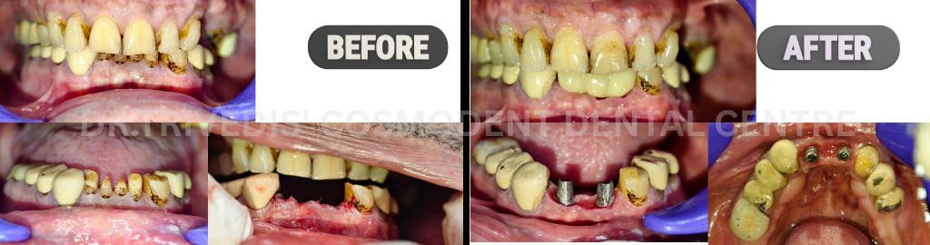 CASE 177 Dental Implants
